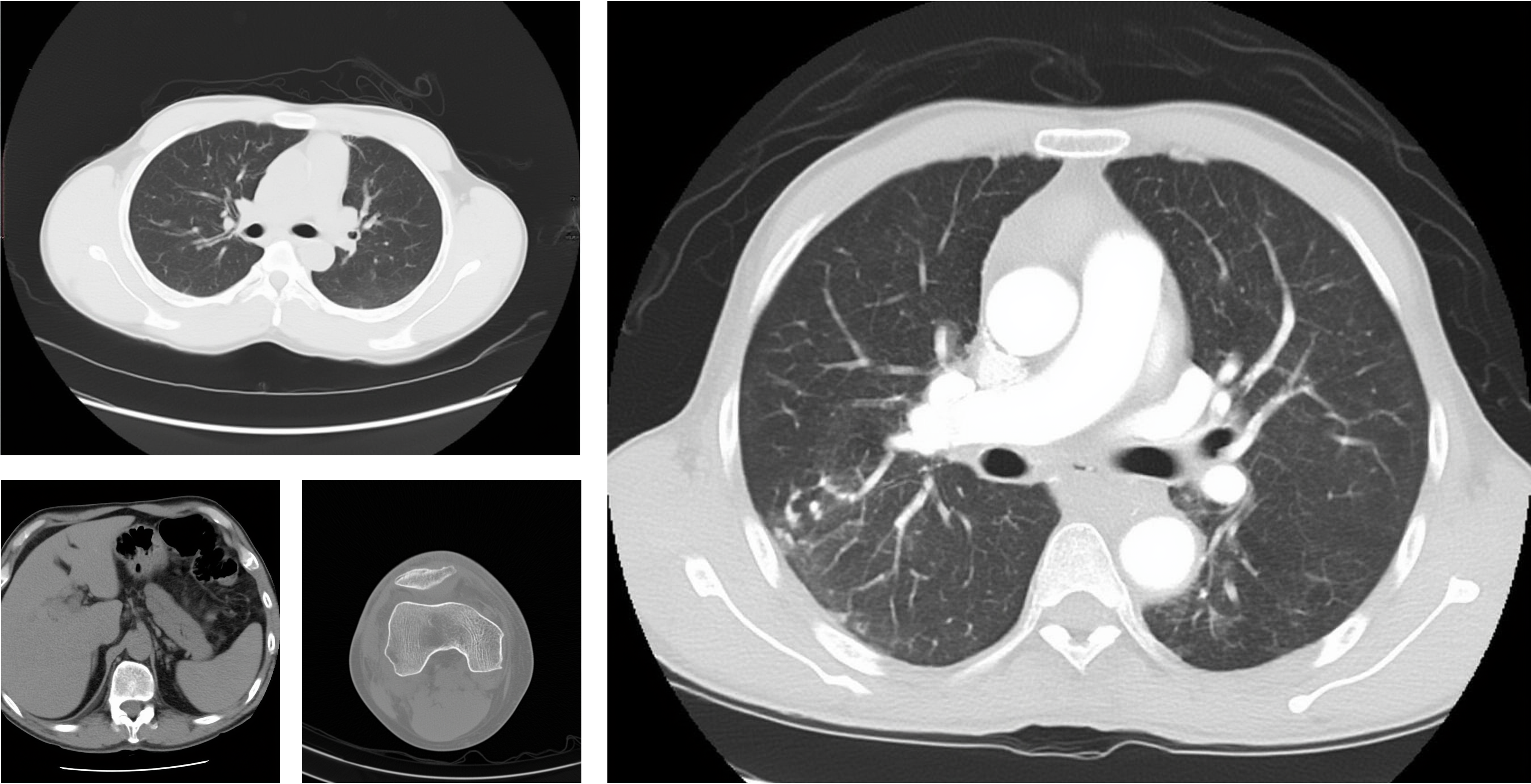 CT Scan